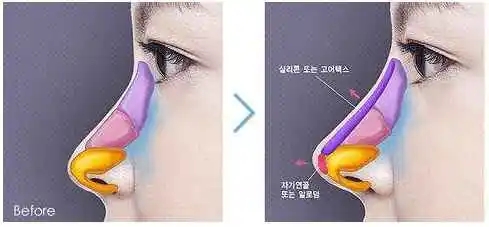 耳软骨垫鼻尖会刺穿鼻尖吗？有哪些注意事项?