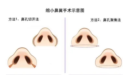 鼻翼不对称矫正手术是恒久的吗？