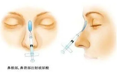 玻尿酸注射隆鼻的成果好吗？
