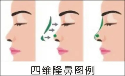 垫鼻梁整形的方法有哪些?