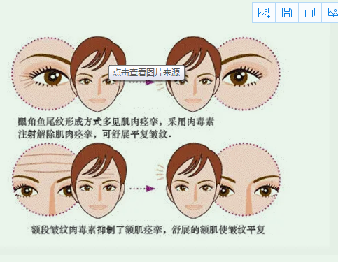 去掉抬头纹要多少钱?注射去抬头纹的方法怎么样?成果好不好?