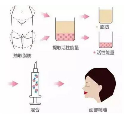 自体脂肪丰太阳穴的步骤