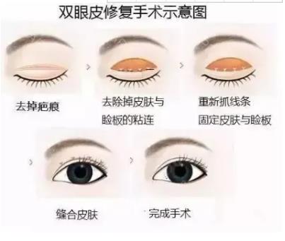 双眼皮修复手术类型，术后护理如何做？