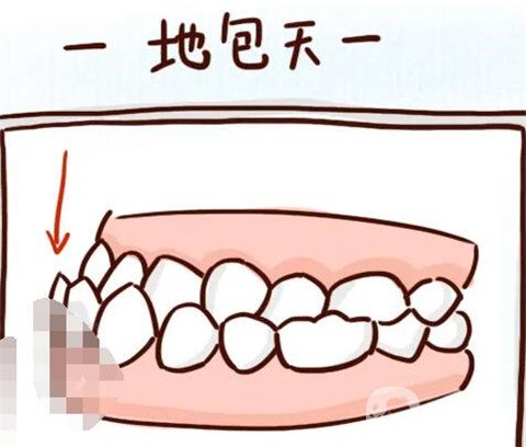 地包天是如何形成的？地包天怎么纠正？