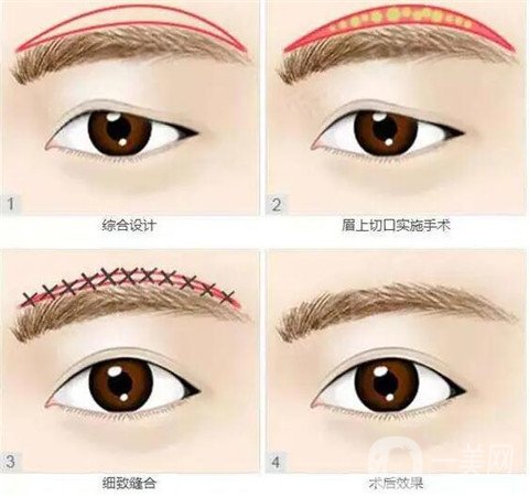提眉手术有哪些成果？术后的注意事项