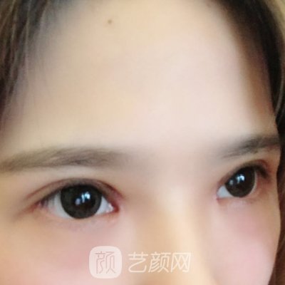 武汉真美啦整形医院做双眼皮怎么样？医院实力及实例展示