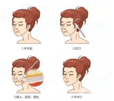 电波拉皮的作用是什么？有什么副作用吗
