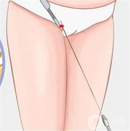 等离子光纤溶脂有危害吗 有什么危害呢？