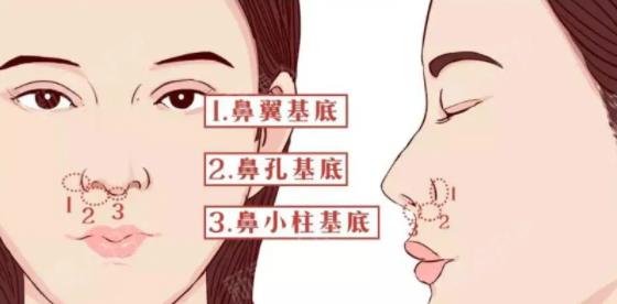 垫鼻基底失败如何修复？有哪些注意事项?