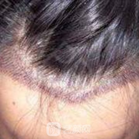 苏州美莱整形医院毛发种植实例公布｜附亲测体验成果图