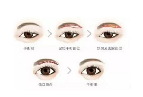 切眉后不自然怎么办
