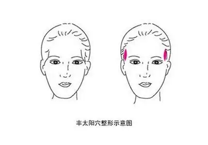 丰太阳穴存在危险吗？有什么后遗症?