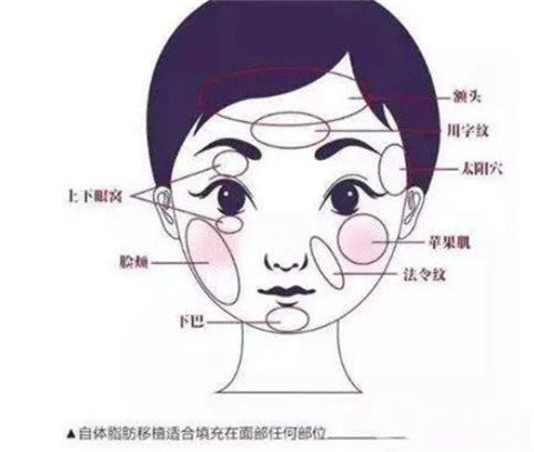 如果自体脂肪填充太多不采取补救措施会发生什么？