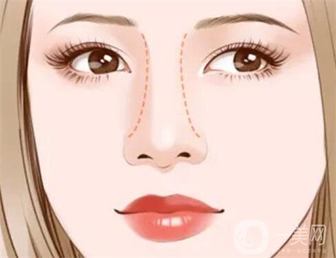 膨体隆鼻术的手术方法？手术材料有什么特点？
