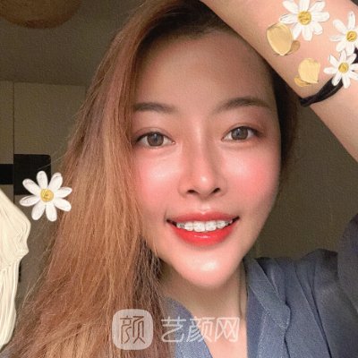 深圳欢乐口腔医院怎么样？牙齿正畸实例及成果图出炉