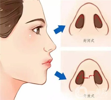 西京整形科介迢一医生隆鼻咋样？真实实例细节供参考！附全新医美价格收费表