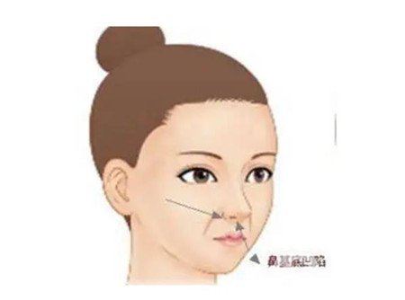 西京整形科介迢一医生隆鼻咋样？真实实例细节供参考！附全新医美价格收费表
