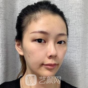 成都杨迪做双眼皮修复手术怎么样？技术如何？看看实例点评