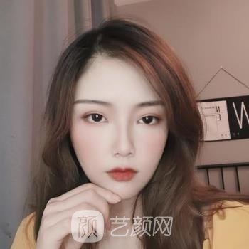 成都杨迪做双眼皮修复手术怎么样？技术如何？看看实例点评