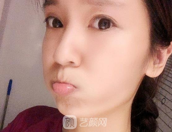 昆明杨穗面部年轻化实例出炉｜2022全新体验实例出炉