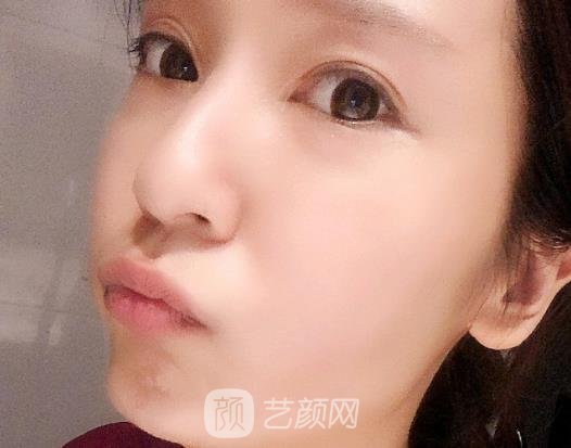 昆明杨穗面部年轻化实例出炉｜2022全新体验实例出炉