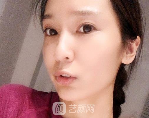 昆明杨穗面部年轻化实例出炉｜2022全新体验实例出炉