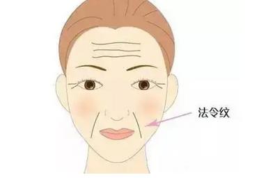 有哪些常见的法令纹类型，玻尿酸可以用来填充法令纹吗