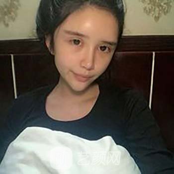 谢红权做的脂肪填充怎么样？医生简介+脂肪填充面部实例