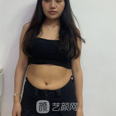 厦门欧菲吸脂靠谱吗？全新实例及成果图展示