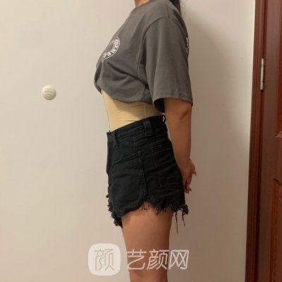 厦门欧菲吸脂靠谱吗？全新实例及成果图展示