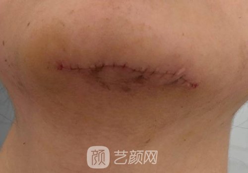 上海虹桥医院整形科疤痕修复实例公开｜附体验成果图