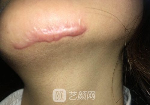 上海虹桥医院整形科疤痕修复实例公开｜附体验成果图