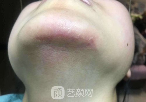上海虹桥医院整形科疤痕修复实例公开｜附体验成果图