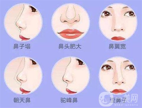 湖南省人民医院整形美容科隆鼻*果如何？看价格表及实例实述