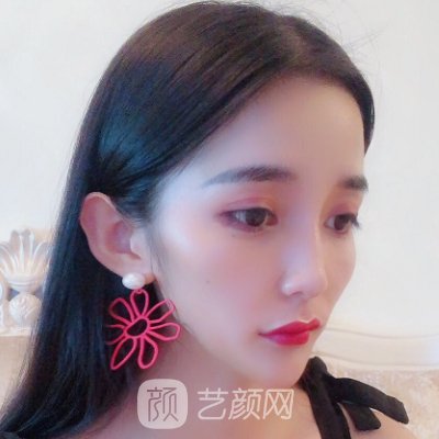 长春朝医做双眼皮怎么样？2022医院热门实例出炉