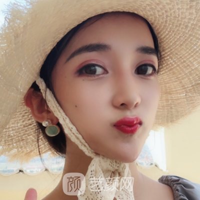 长春朝医做双眼皮怎么样？2022医院热门实例出炉