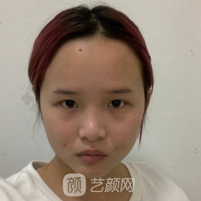长春卓研整形医院怎么样？面部除皱实例及成果图出炉