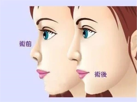 鼻翼切除后会留疤吗，怎么处理？