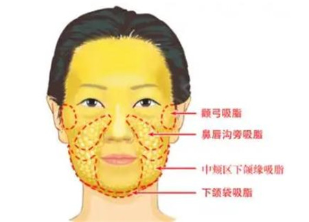 吸脂后脂肪减少会导致皮肤松弛吗