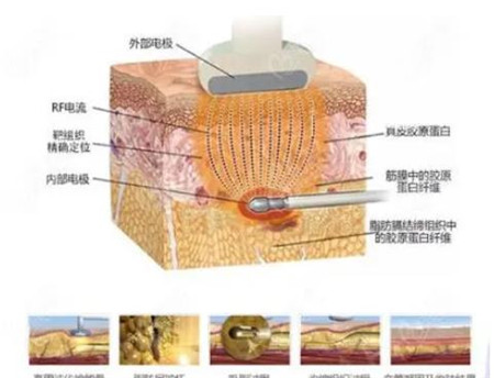 夏天吸脂怎么样