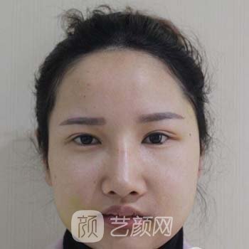 杜本军颧骨内推价格贵吗？技术点评诊疗特色，附实例