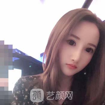 杜本军颧骨内推价格贵吗？技术点评诊疗特色，附实例