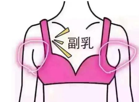 副乳切除术有什么优势?