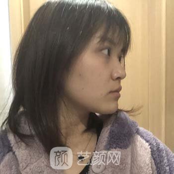 西安西京医院美容科孙峰坐诊时间|医生简介|双眼皮实例
