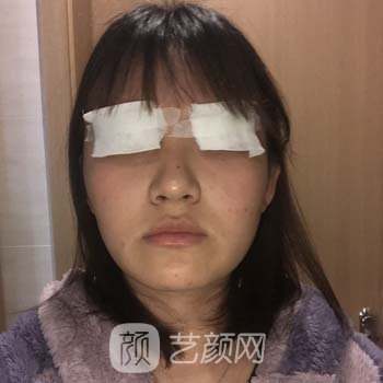 西安西京医院美容科孙峰坐诊时间|医生简介|双眼皮实例