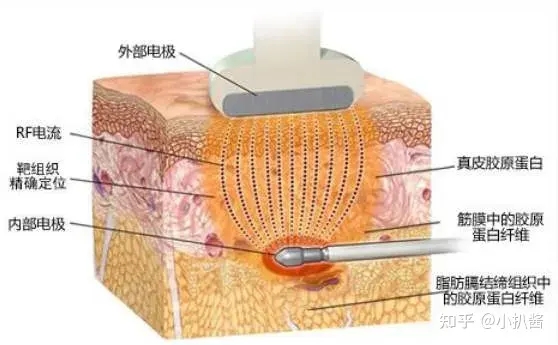 射频紧肤成果如何，有没有用？