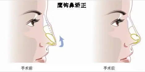 鹰钩鼻的矫正原理，矫正鹰钩鼻安好吗