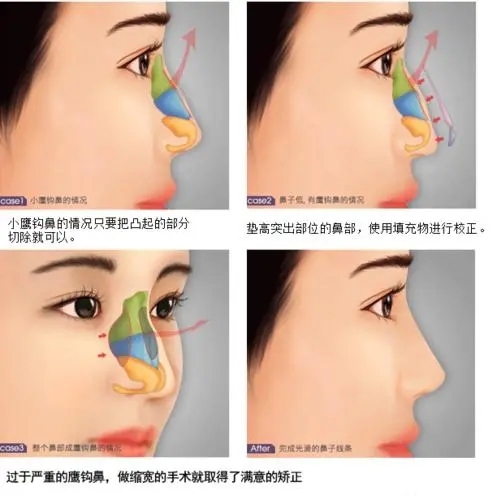 鹰钩鼻矫正的步骤，鹰钩鼻矫正适合哪些人?