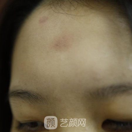 朔州丽都整形医院疤痕修复技术怎么样？2022招牌实例展示