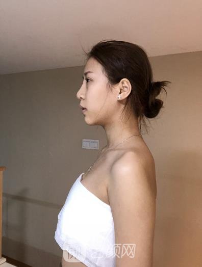 应胜华自体脂肪填充好吗？医生简介+自体脂肪隆胸实例